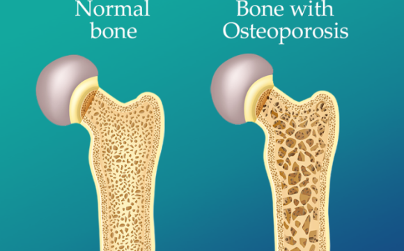 پوکی استخوان، دشمن خاموش سالمندی است