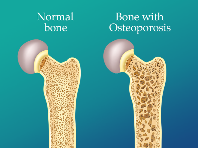 1684503081-osteoporosis-doctor in saharanpur پوکی استخوان، دشمن خاموش سالمندی است